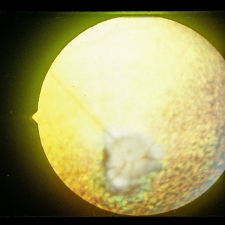 Progressive Retinal Atrophy