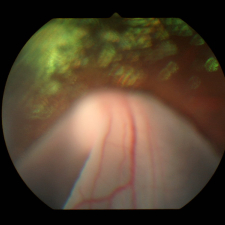Retinal Detachment