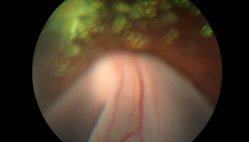 Retinal Detachment photo
